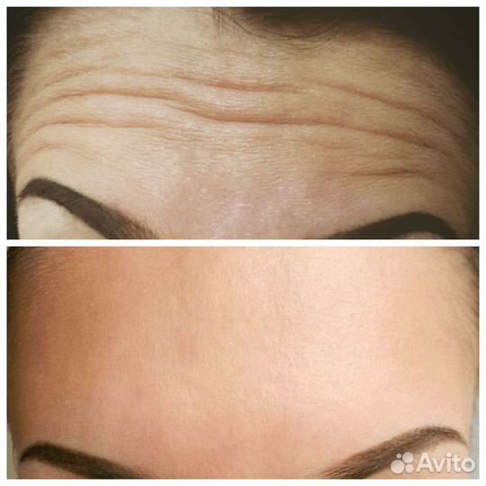 Удаление морщин