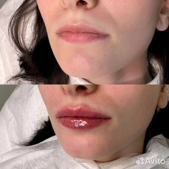 Увеличение губ
