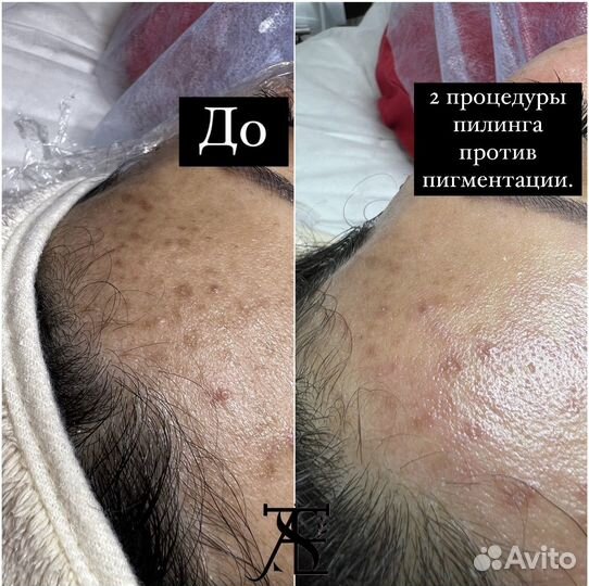 Чистка лица + пилинг в подарок