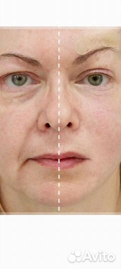 Нитевой лифтинг