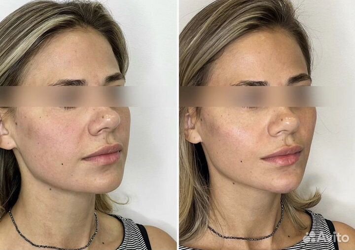 Углы Джоли/ коррекция скул