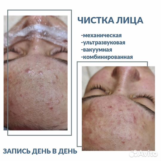 Чистка лица