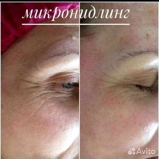 Чистка лица,пилинги