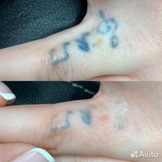 Лазерное удаление тату и татуажа