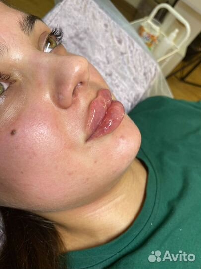 Увеличение губ