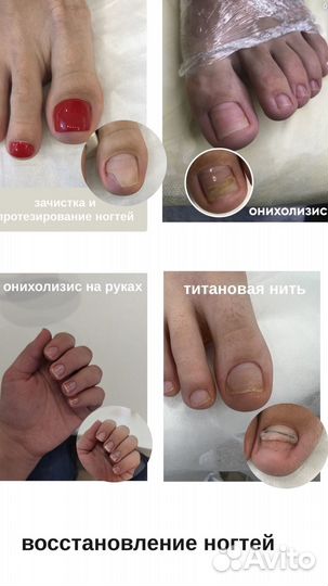 Медицинский Педикюр Подолог Вросший ноготь