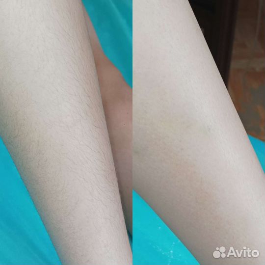 Шугаринг
