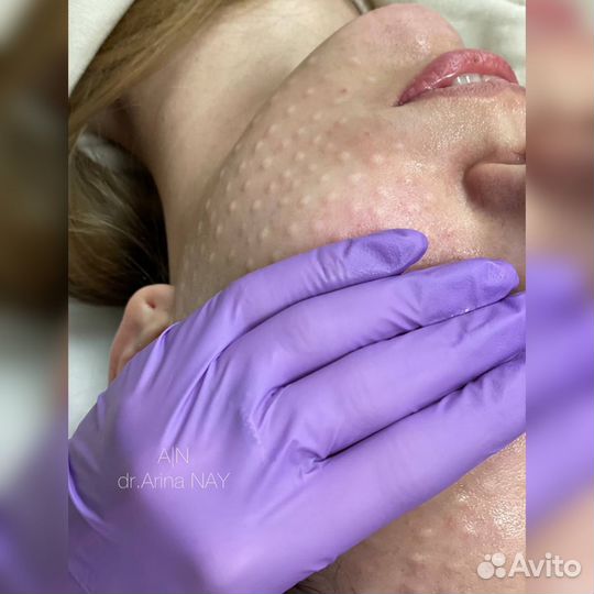 Услуги косметолога.Инъекции для красоты лица и губ
