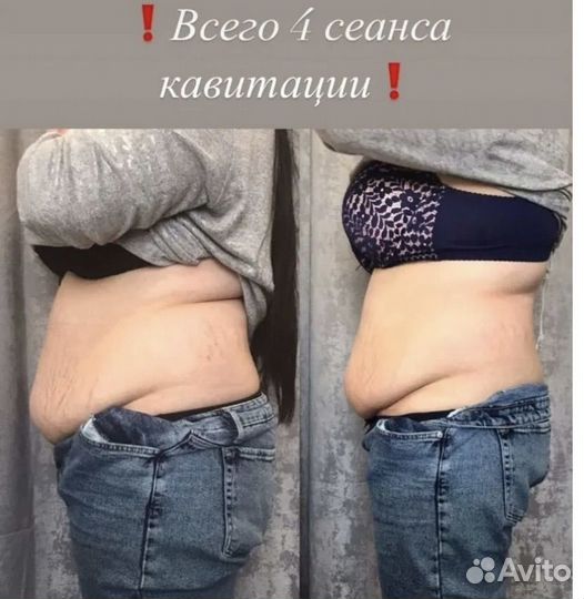 Антицеллюлитный массаж Аппаратная коррекция