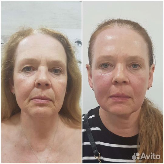 Массаж - (ручная пластика лица )