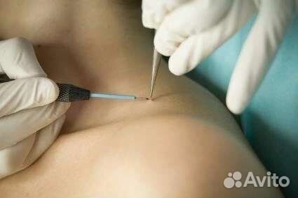 Удаление папилом