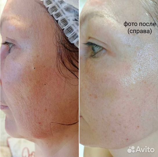 Full face (лицо под ключ) Ступино Московия