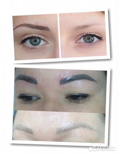 Удаление татуажа перманентного макияжа