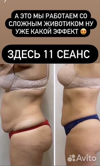 Вакуумный массаж
