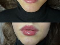 Контурная пластика губ