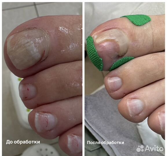 Подолог, педикюр