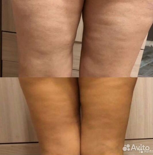 Антицеллюлитный массаж