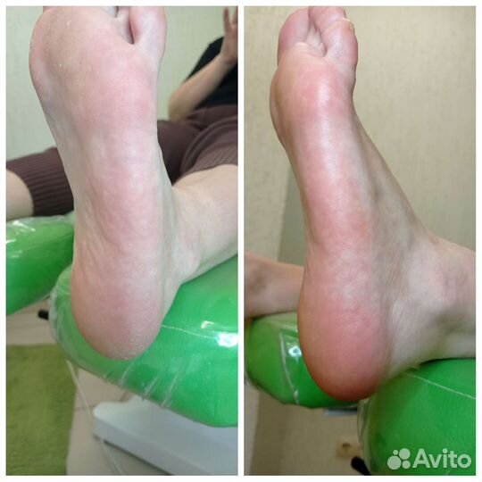 Аппаратный педикюр, комбинированный педикюр