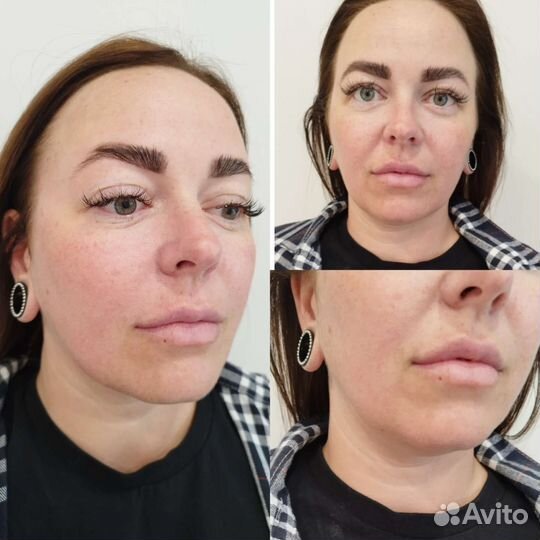 Смас-лифтинг Ультраформер