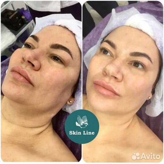 Фракционная мезотерапия/ дермапен премиум составы