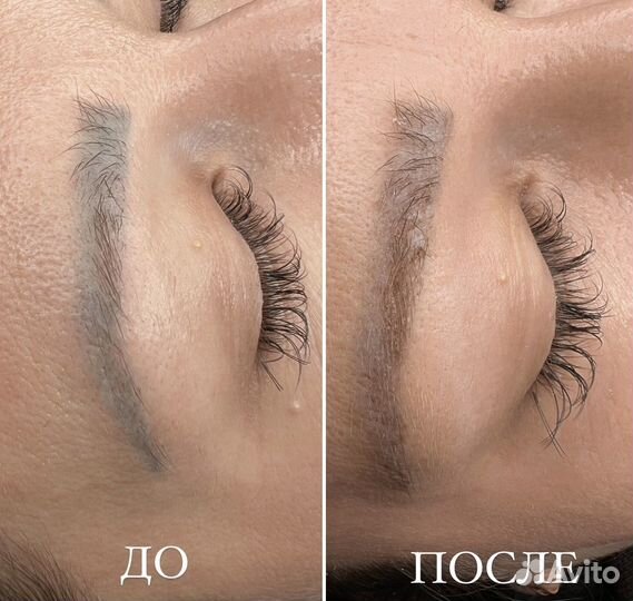 Удаление татуажа перманентного макияжа бровей губ