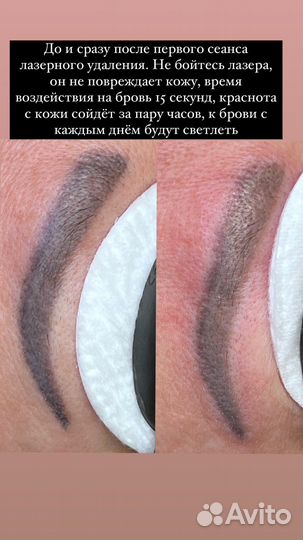 Удаление татуажа бровей, губ, татуировок