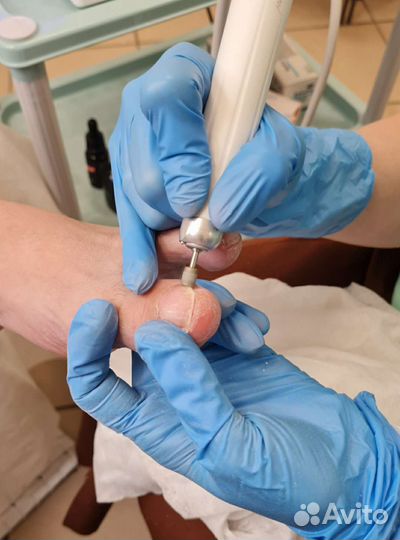 Подолог. Вросший ноготь. Грибок. Титановая нить