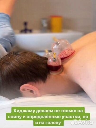 Лазерная эпиляция