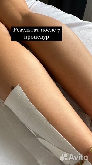 Лазерная эпиляция