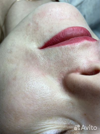 Электроэпиляция