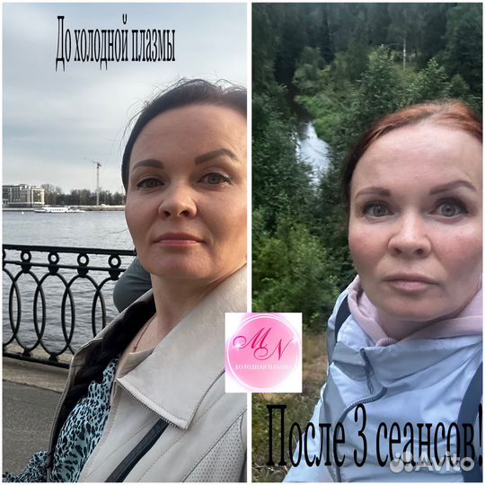 Холодная плазма - супер омоложение без уколов