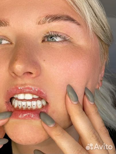 Скайсы на зубы