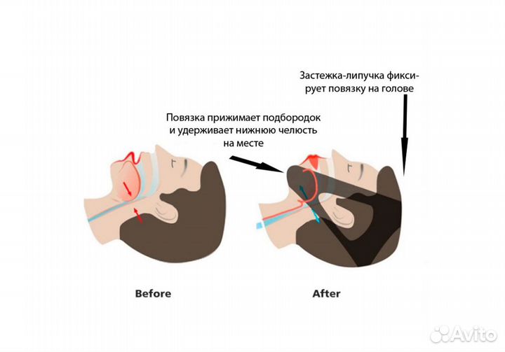 Повязка-бандаж 