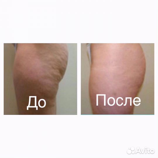 Массаж,Прессотерапия, похудение