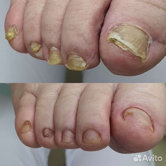 Педикюр, подолог, трещины,натоптыши,грибок и т.д