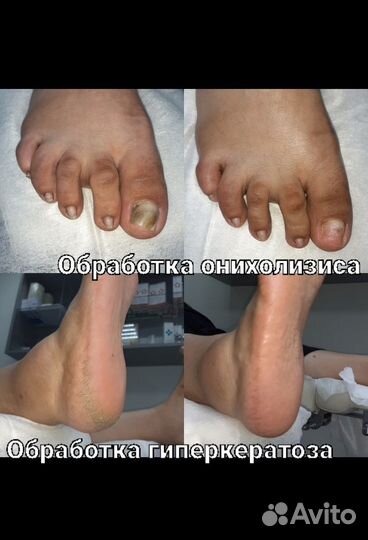 Подолог, аппаратный педикюр