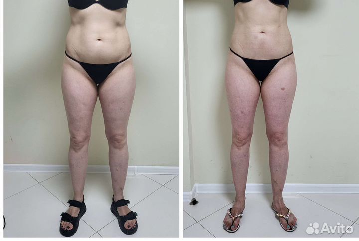 Антицеллюлитный массаж