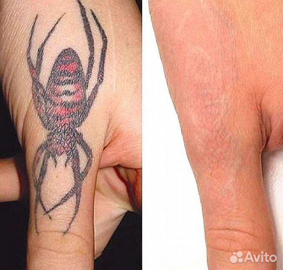 Удаление татуировок