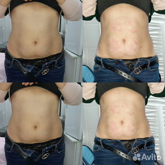 Роликовый массаж (бьютилазер)