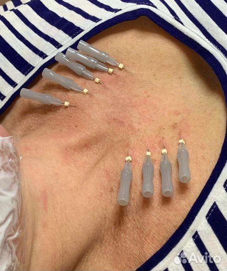 Мезонити (Тредлифтинг)