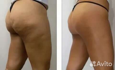 Антицеллюлитный массаж/Кавитация/RFлифтинг/Вакуум