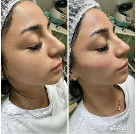 Плазмолифтинг