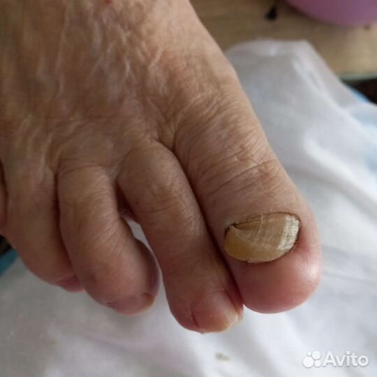 Медицинский педикюр на дому