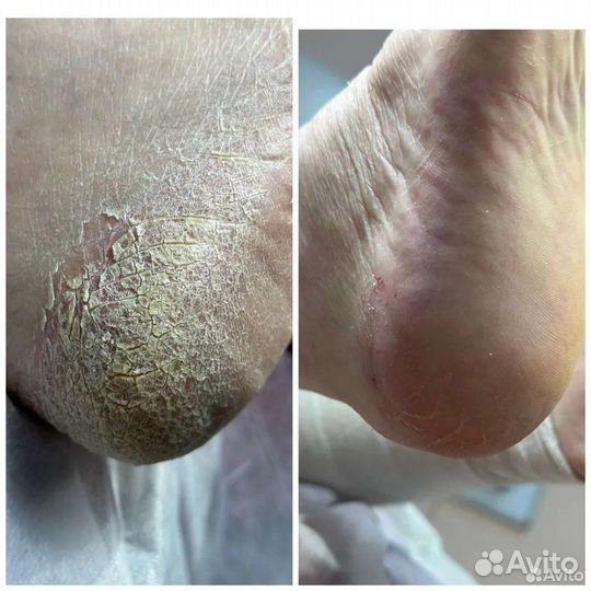 Подолог, SMART- педикюр