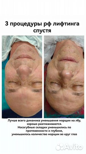 Массаж лица. Подтяжка лица. RF-лифтинг