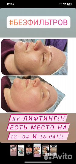 Лазерная эпиляция,фотоомоложение,rf лифтинг