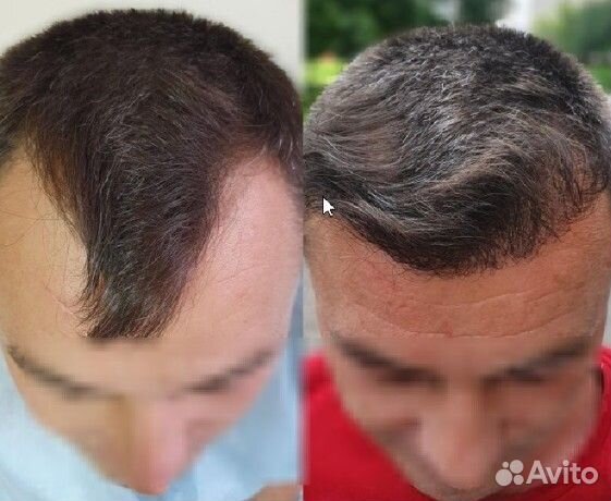 Пересадка волос передовыми методами