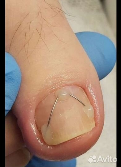 Вросший ноготь