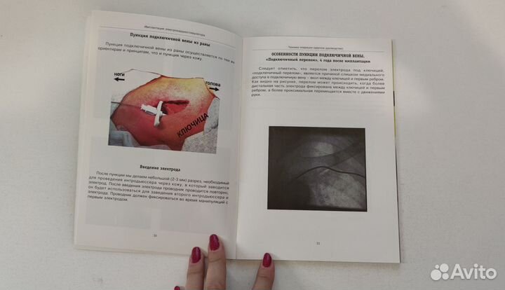 Имплантация электрокардиостимулятора.Диденко М.В