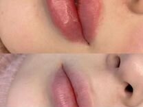 Увеличение губ/контурная пластика губ